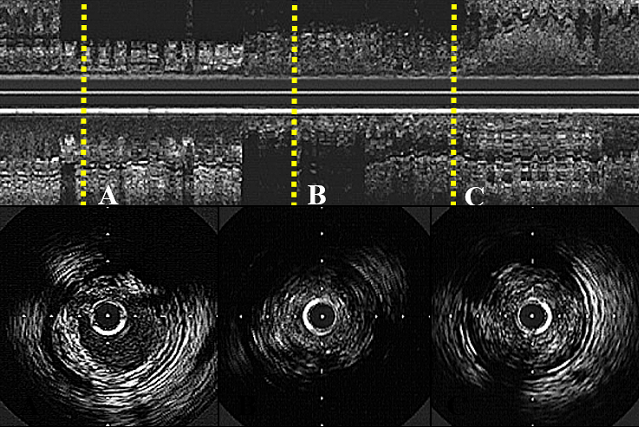 VAMPIRE 3: Attenuated Plaque May Signal Benefit of Thrombus Removal in PCI