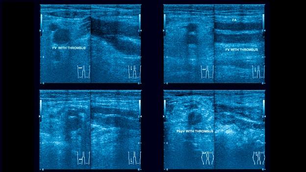 Attacking DVT With Drug-Device Combo Does Not Reduce Postthrombotic Syndrome 