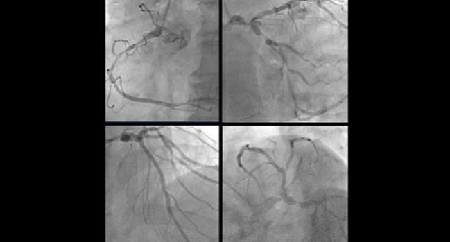 PCI Comparable to CABG in Left Main Coronary Disease: Meta-analysis