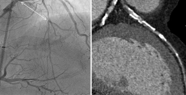 Myocardial Perfusion Imaging May Enhance CT-Based Evaluation of Stable Angina: CRESCENT II