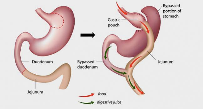 Bariatric Surgery: Cardiometabolic Benefits Down, but Not Out, at 5 Years