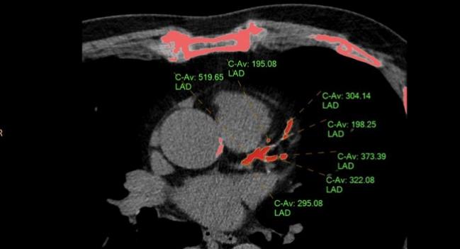 ‘Nontraditional’ CAC, CRP, or ABI Risk Tools Not Recommended, Says USPSTF