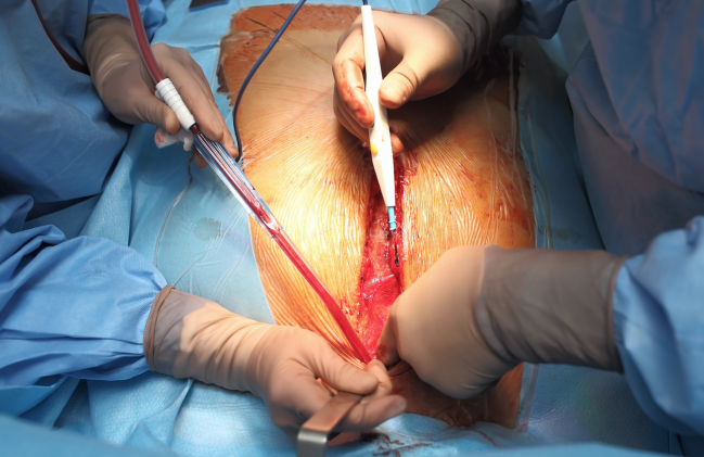 Largest Study to Date Supports Surgical LAA Closure in A-fib Patients