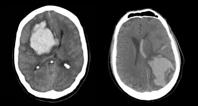 Experts Debate: Is It ‘Nuts’ to Restart Anticoagulation After Lobar ICH?