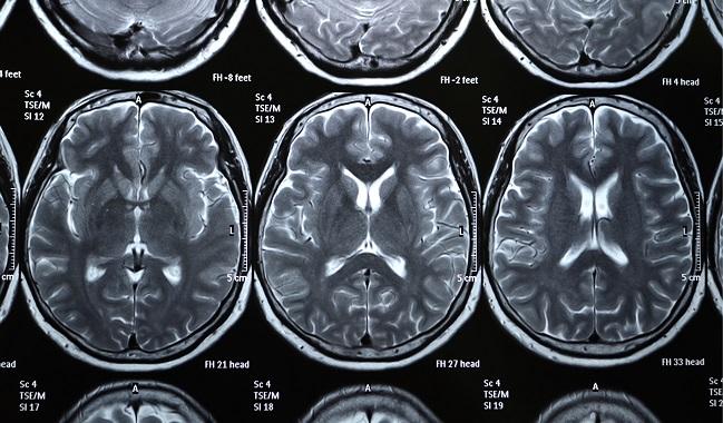 Existing Neurocognitive Deficits Cloud Interpretation of Post-TAVR Changes: SENTINEL Analysis