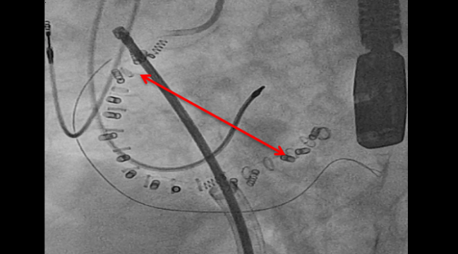 Edwards Voluntarily Recalls Cardioband ‘Anchors’ Used in Mitral and Tricuspid Repair