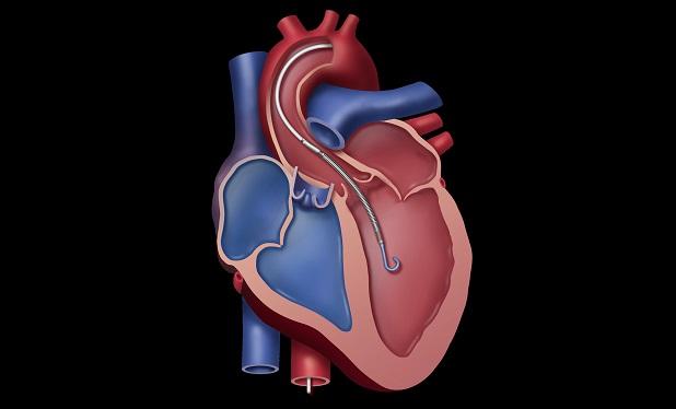 Impella Heart Pumps Get Expanded Indication for Cardiogenic Shock in Setting of Cardiomyopathy 