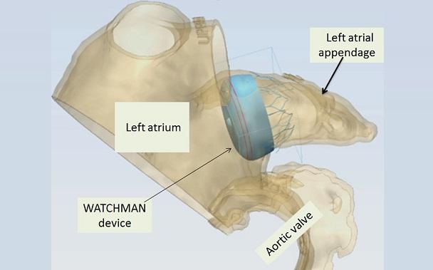 More Data Hint at the Superiority of 3D Imaging for LAA Occlusion