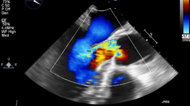 Transcatheter Fix for Native Aortic Valve Regurgitation ‘Not Optimal’ but Getting Better
