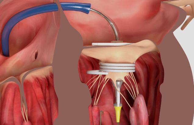 Early Results for Dock-Plus-Valve Approach Promising in Transcatheter Mitral Valve Replacement