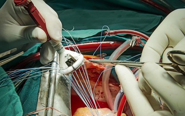 New Surgical Valve Durability Data Set ‘Critical Benchmark’ for TAVR Devices