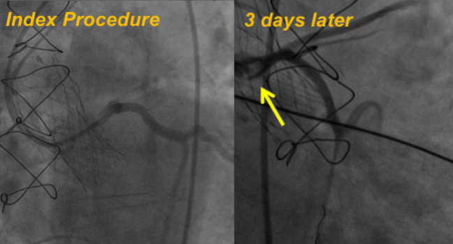 Delayed Coronary Obstruction After TAVR: Prevalence, Causes, and Solution Explored for Deadly Complication