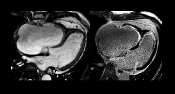 Silent MI Often Precedes Acute MI, Portends Worse Patient Outcomes