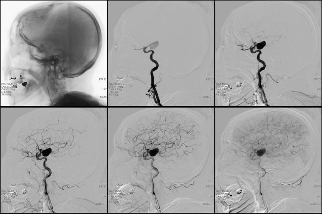 Real-World Study Raises Concerns About Initiating Carotid Stenting in Acute Phase 