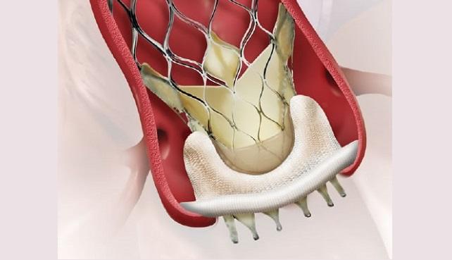 Valve-in-Valve TAVR: Mortality, Adverse Events Similar to Redo Surgery at 30 Days