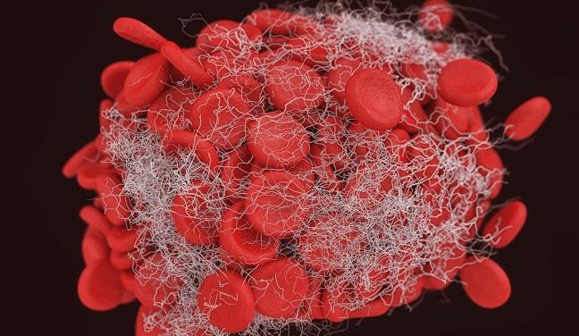 Thrombus on the Watchman LAA Occluder Tied to Higher Stroke Risk