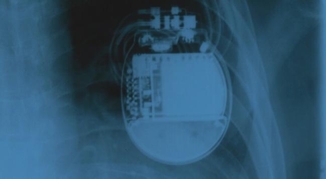 Certain CAD Subgroups Without Severe HF Face Heightened Risk of Sudden Cardiac Death