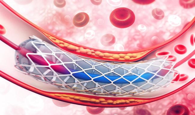 Plaque Dislodgement Less Frequent With Transradial vs Transfemoral PCI 