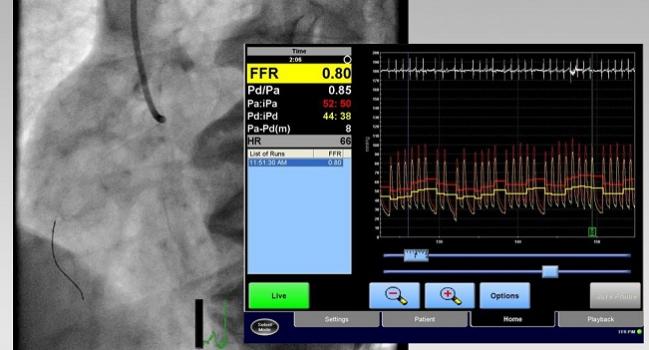 FFR in PCI for Stable CAD: Lasting Benefit Shown by FAME 2, SCAAR Data