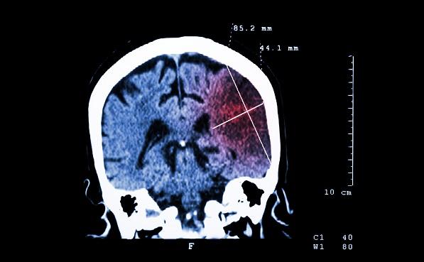 Platelet Reactivity Linked With Ischemic Stroke Risk Post-DES Implantation: ADAPT-DES Substudy