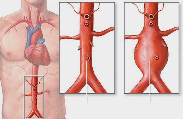 FDA Identifies Culprit in Endovascular Graft Type III Endoleaks 