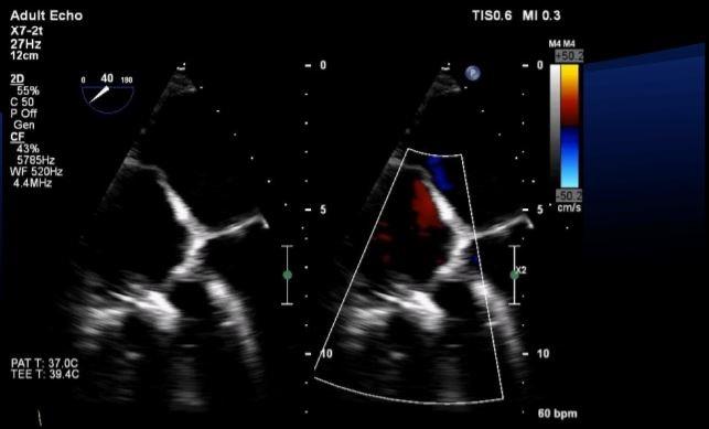 Percutaneous Edge-to-Edge Repair for Tricuspid Regurgitation: Some Successes, Some Caveats