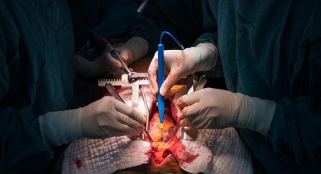 Many Invasive Procedures, Including Cardiovascular, Up Risk of Infective Endocarditis