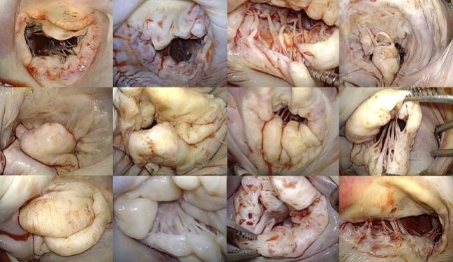 Will Percutaneous Mitral Repair Catch Up or Surpass Surgery? Experts Make Their Predictions 