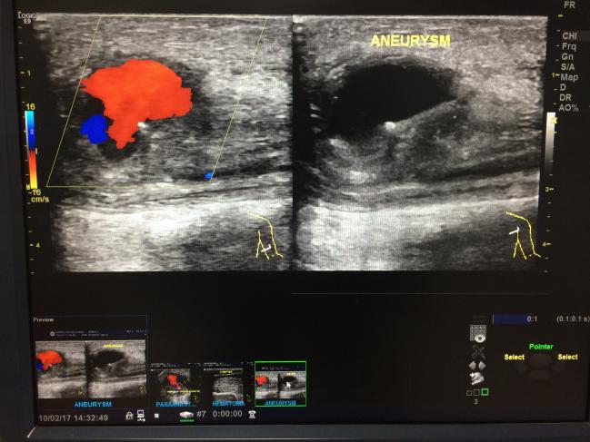 Screening Programs for Abdominal Aortic Aneurysm Need a Rethink, Swedish Study Contends