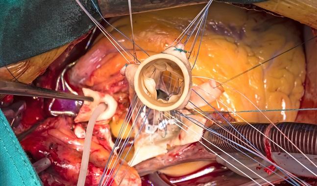 Hemodynamic Deterioration Post-SAVR: Dysmetabolic Profile, Calcification Could Be Early Warning Signs