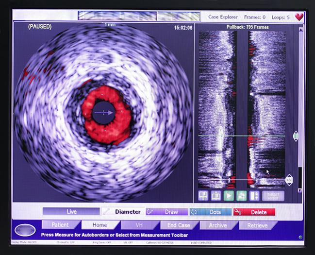 SCAI Updates Statement on Intracoronary Diagnostic Tools