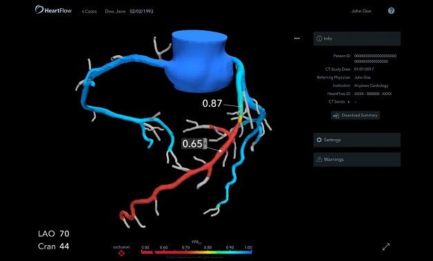 FFRCT Shifts Patient Management, Linked to Better 90-Day Outcomes: ADVANCE Registry