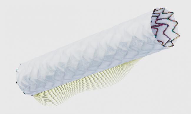 FDA Approves New Covered Stent Option for Coronary Perforations