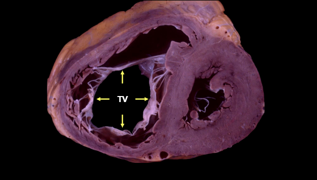Ventricular vortex loss analysis due to various tricuspid valve repair  techniques: an ex vivo study