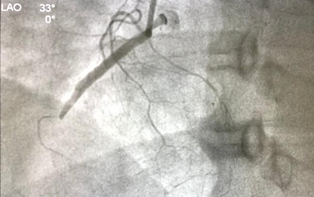 CTO PCI Patients With CKD Have More Acute Kidney Injury but Not Dialysis or TLF Over 2 Years