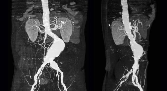 FDA: All AFX Endovascular AAA Systems Now Under Class I Recall 