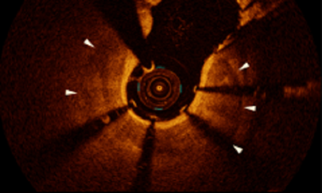 PREPARE-CALC Shows Benefits of Rotational Atherectomy