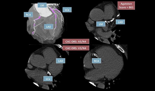 Statins Provide No Clinical Benefit When Coronary Calcium Is Zero, Study Shows