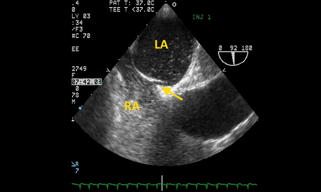 European Guidelines Represent First Intersocietal Position on Percutaneous PFO Closure