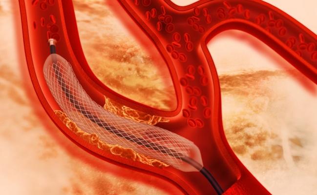 New-Generation DES Better Than Older Stents Over 10 Years, Regardless of Polymer Type