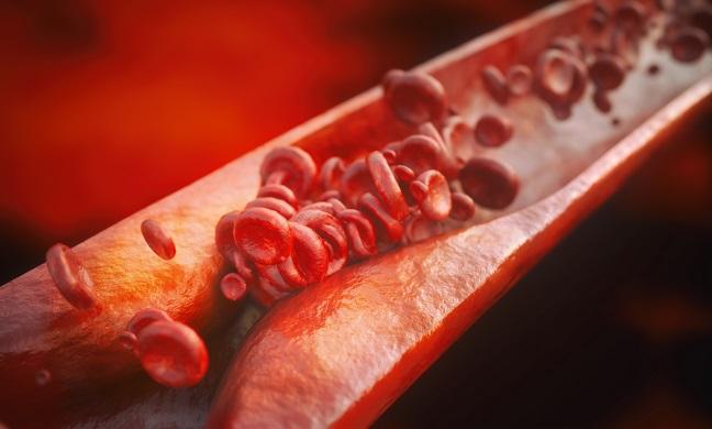 ‘Accelerated Atherosclerosis’ Not Uncommon in Arteries of Young People