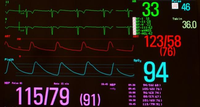 Bradycardia Guidelines Offer Tips on Diagnosis, Management