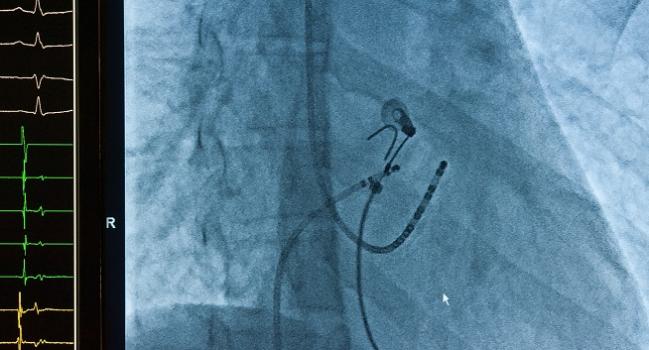 Catheter Ablation Boosts Outcomes in Patients With A-fib and Heart Failure: Meta-analysis