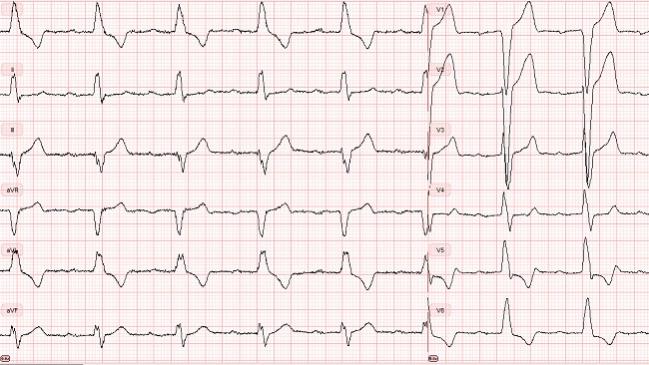 Half of TAVR Patients Develop Potentially Dangerous Conduction Abnormalities