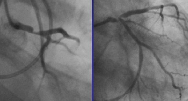 Unprotected Left Main PCI? US Interventionalists Aren’t Biting (Yet)