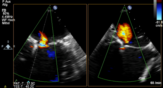 MitraClip Analysis Highlights Questions of Patient Selection in Functional MR