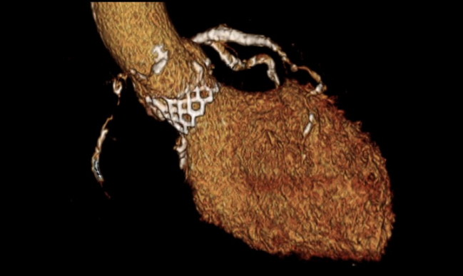 New CT Guidelines for TAVR Emphasize Standardization, 4-D Acquisition, and Postprocedural Imaging