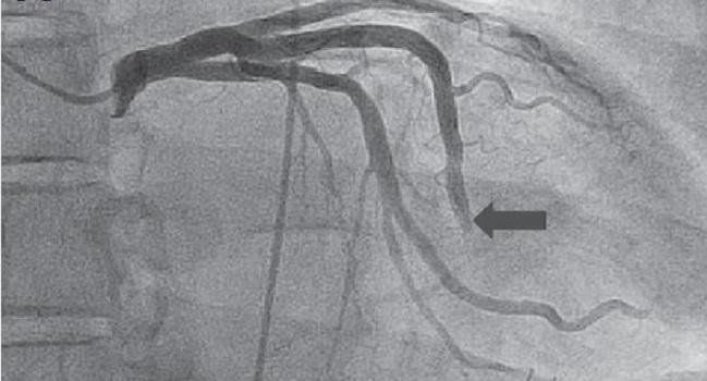 Nicardipine Alleviates ‘Slow Flow’ in Chest-Pain Patients Without Obstructive CAD