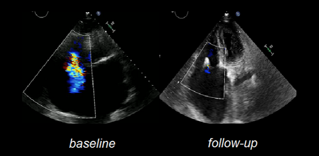 Tricuspid Valve Interventions in High-Risk Patients: Midterm Outcomes Encouraging in TriValve Registry