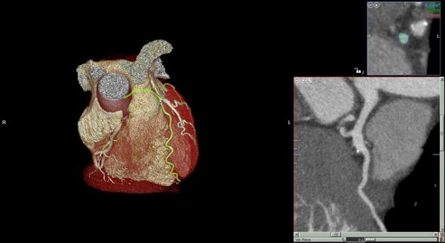 CT Angiography Bests Functional Testing in Diabetic Patients With Chest Pain: PROMISE